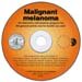 Malignt melanom